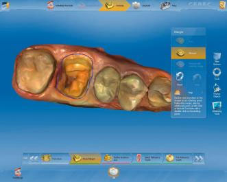 CEREC AC OMNICAM ПРОСТОЕ СКАНИРОВАНИЕ БЕЗ АНТИБЛИКОВОГО СПРЕЯ 12.jpg CEREC AC OMNICAM ПРОСТОЕ СКАНИРОВАНИЕ БЕЗ АНТИБЛИКОВОГО СПРЕЯ 12.jpg