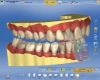 CEREC AC OMNICAM ПРОСТОЕ СКАНИРОВАНИЕ БЕЗ АНТИБЛИКОВОГО СПРЕЯ 18.jpg CEREC AC OMNICAM ПРОСТОЕ СКАНИРОВАНИЕ БЕЗ АНТИБЛИКОВОГО СПРЕЯ 18.jpg